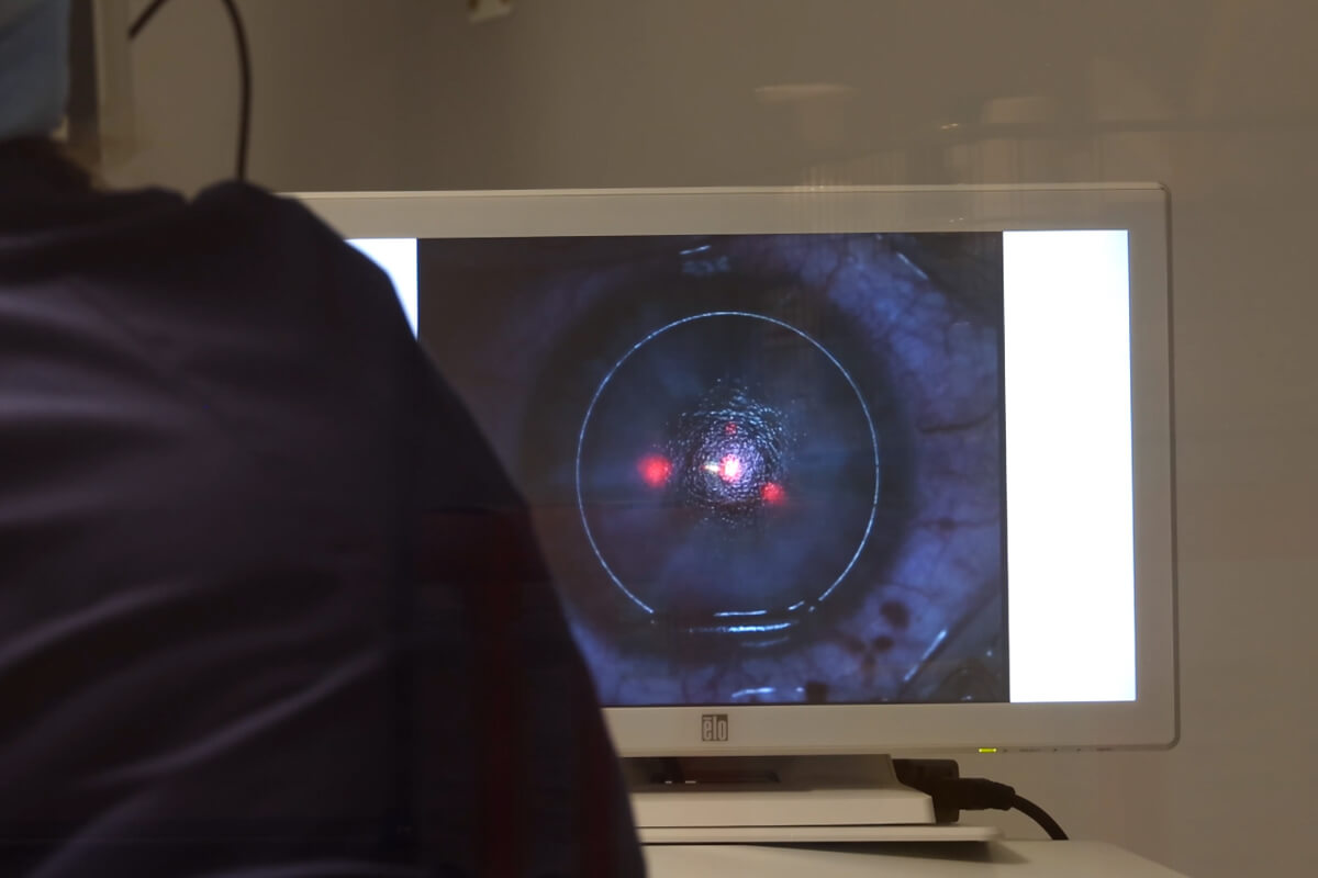 Suivi en temps réel d’une chirurgie de l’œil au laser à Angers et alentours